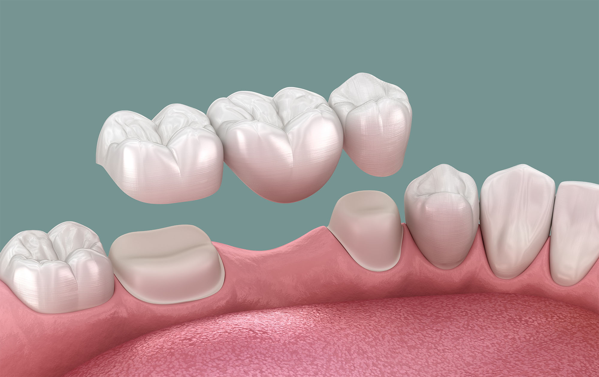 Porcelain Dental Bridges In Winnipeg Cholakis Dental Group Porcelain Dental Bridges In Winnipeg Cholakis Dental Group
